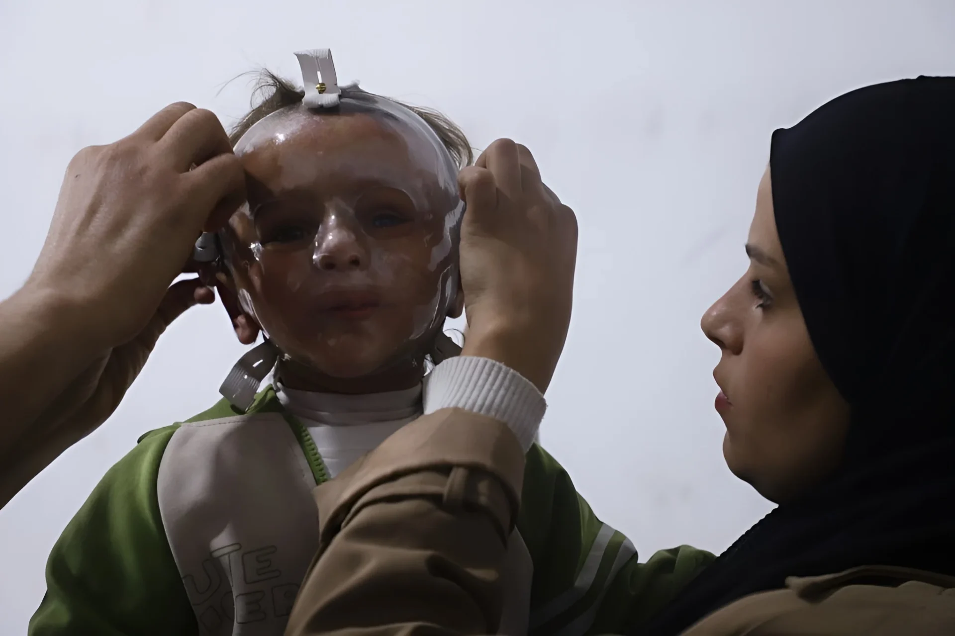 Criança palestina recebe máscara terapêutica em clínica apoiada por Médicos Sem Fronteiras durante tratamento de queimaduras em Gaza